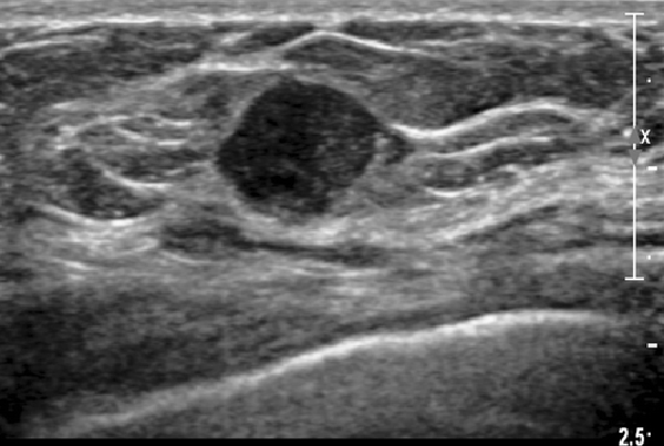 Breast Ultrasound