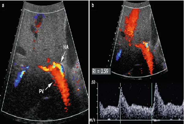 Colour Doppler