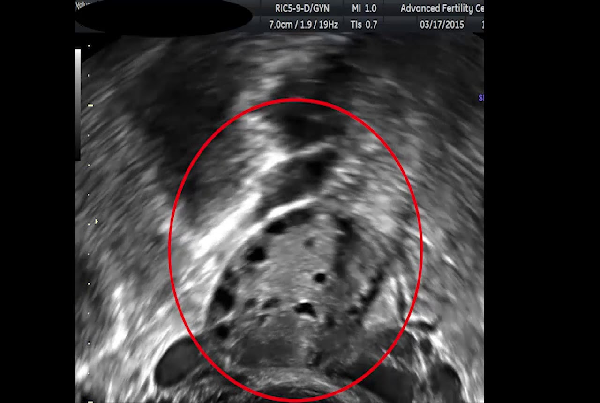 Antral Follicle Count