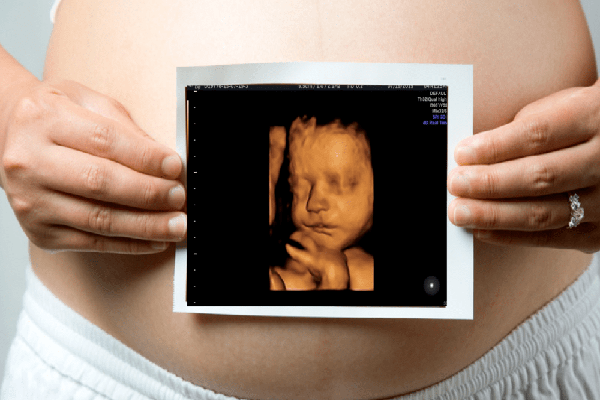 Color Doppler 3D and 4D