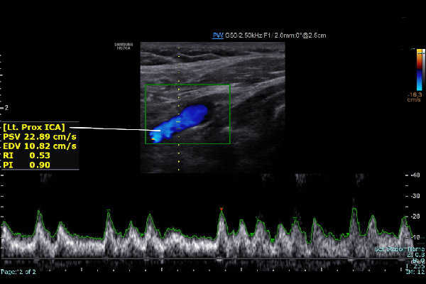 Carotid Doppler