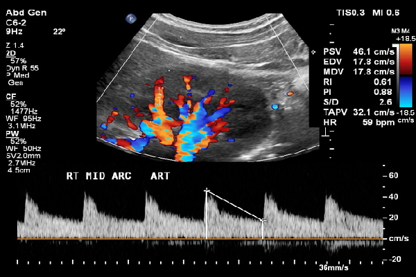 Renal Doppler