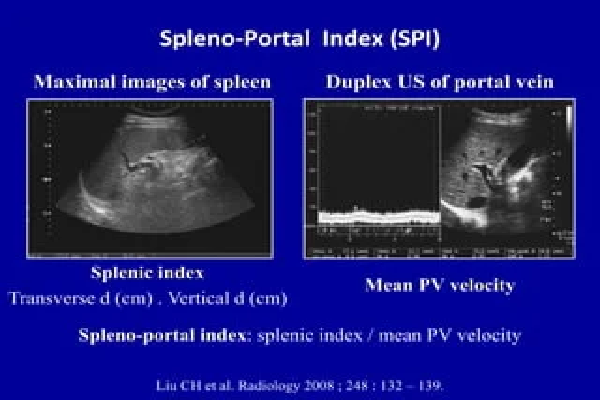 Splenoportal Axis Doppler