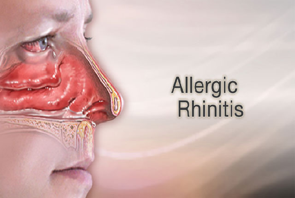 Treatment of Allergic Rhinitis